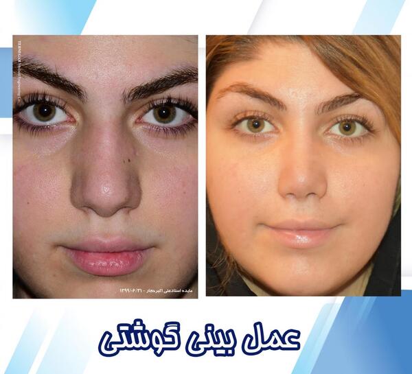 عکس دماغ عملی گوشتی قبل و بعد
