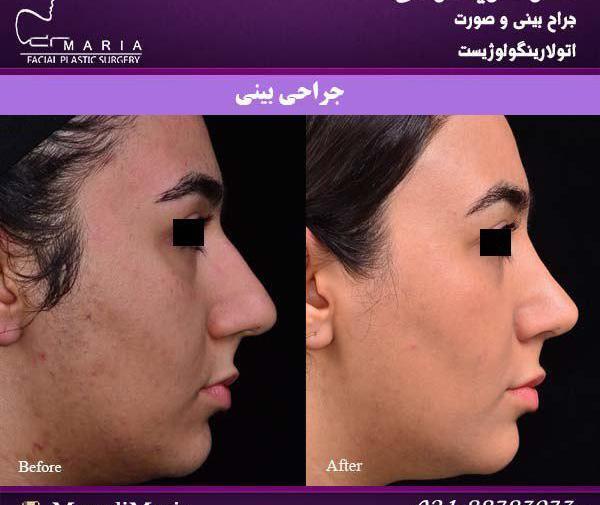 عکس دماغ عملی گوشتی قبل و بعد