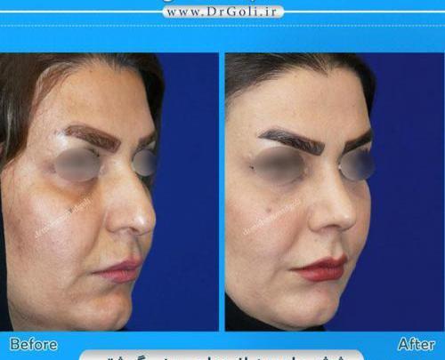 عکس دماغ عملی گوشتی قبل و بعد