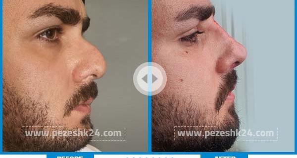 عکس دماغ عملی گوشتی قبل و بعد