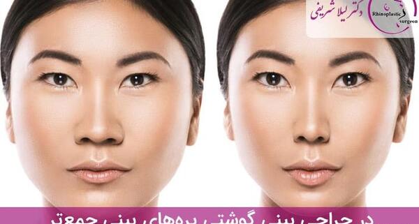 عکس دماغ عملی گوشتی قبل و بعد