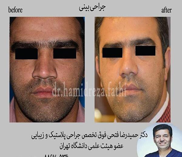 عکس دماغ عملی گوشتی قبل و بعد