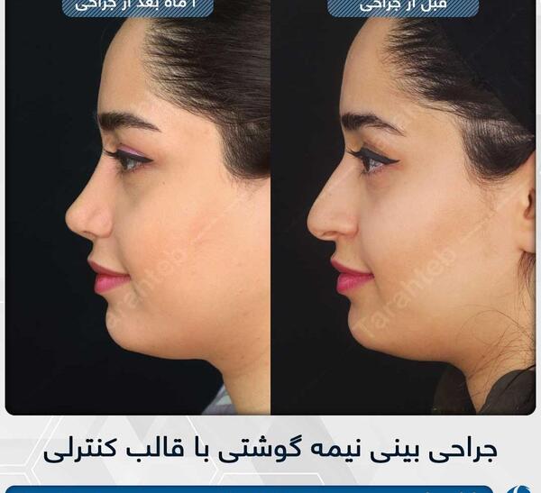 عکس دماغ عملی گوشتی قبل و بعد