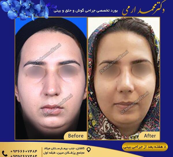 عکس دماغ عملی گوشتی قبل و بعد