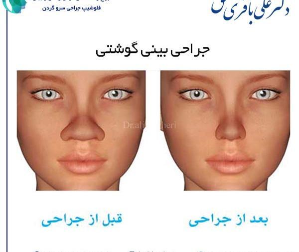 عکس دماغ عملی گوشتی قبل و بعد