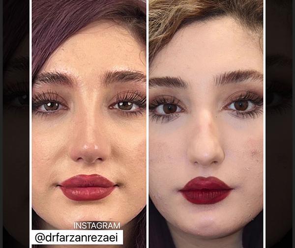 عکس دماغ عملی گوشتی قبل و بعد