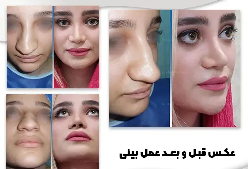 عکس دماغ عملی گوشتی قبل و بعد