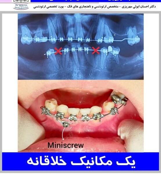 عکس دندان ها قبل و بعد از ارتودنسی