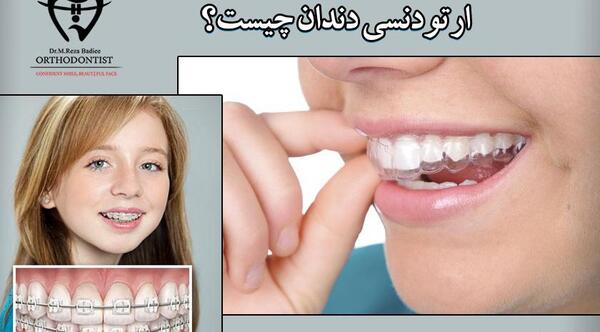 عکس دندان ها قبل و بعد از ارتودنسی