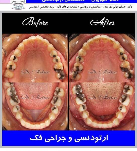 عکس دندان ها قبل و بعد از ارتودنسی