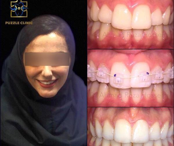 عکس دندان ها قبل و بعد از ارتودنسی
