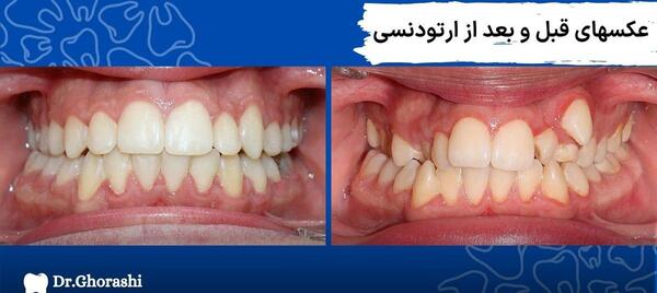 عکس دندان ها قبل و بعد از ارتودنسی