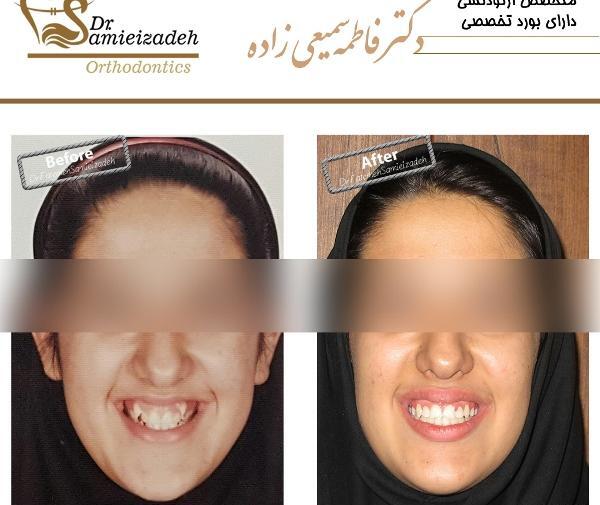 عکس دندان ها قبل و بعد از ارتودنسی