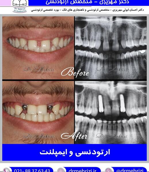 عکس دندان ها قبل و بعد از ارتودنسی