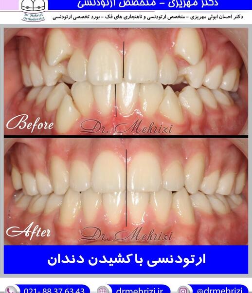 عکس دندان ها قبل و بعد از ارتودنسی