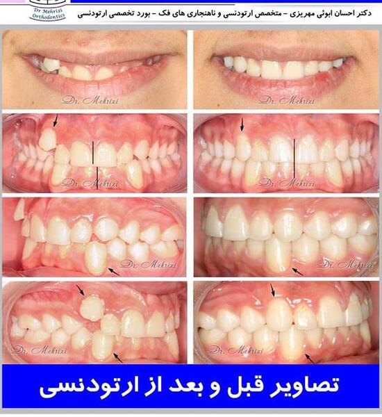 عکس دندان ها قبل و بعد از ارتودنسی