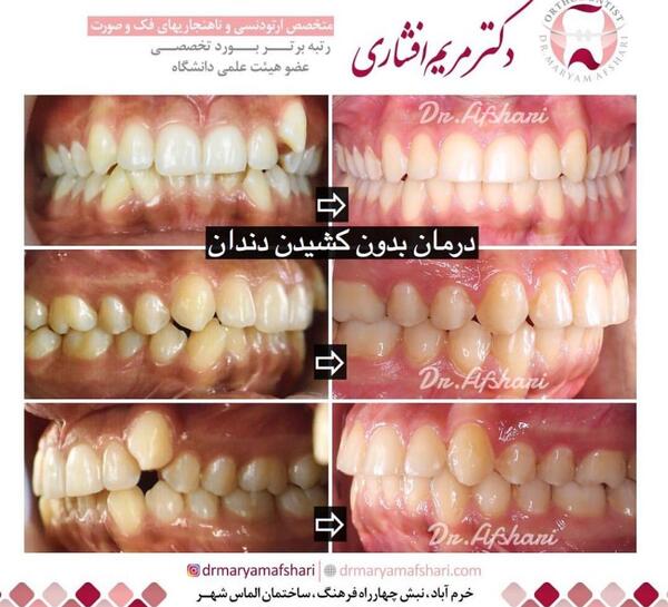 عکس دندان ها قبل و بعد از ارتودنسی