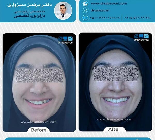 عکس دندان ها قبل و بعد از ارتودنسی