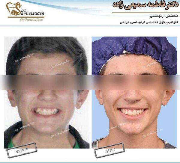 عکس دندان ها قبل و بعد از ارتودنسی