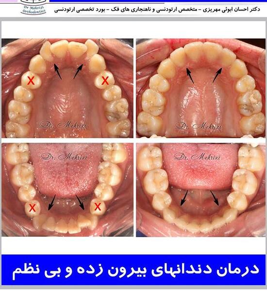 عکس دندان ها قبل و بعد از ارتودنسی