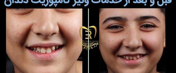 عکس کامپوزیت دندان قبل و بعد