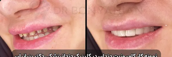 عکس کامپوزیت دندان قبل و بعد