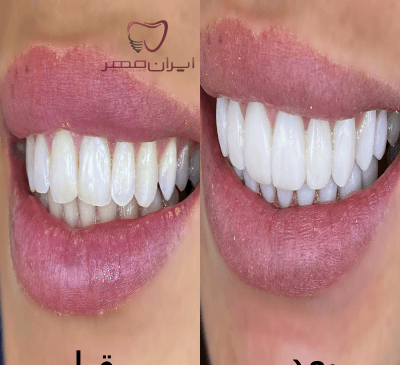 عکس کامپوزیت دندان قبل و بعد