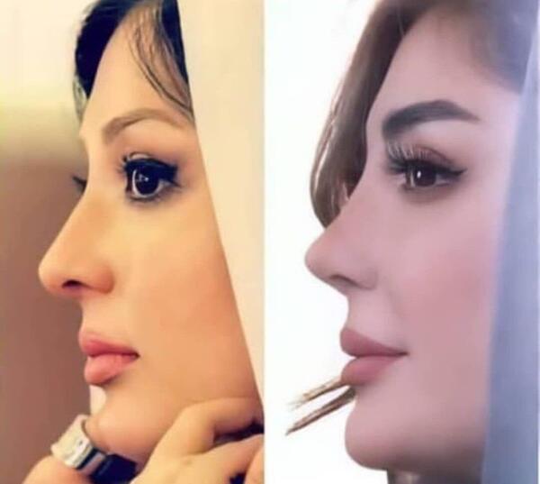 عکس های نیوشا ضیغمی قبل از عمل زیبایی
