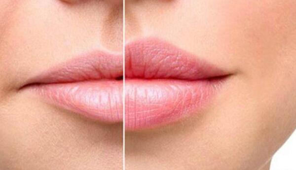 عکس قبل و بعد ژل لب روسی
