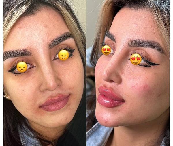 عکس قبل و بعد ژل لب روسی
