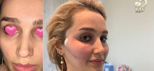 عکس قبل و بعد ژل لب روسی