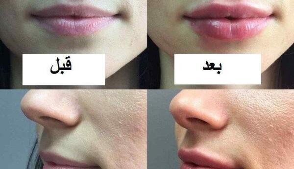 عکس قبل و بعد ژل لب روسی