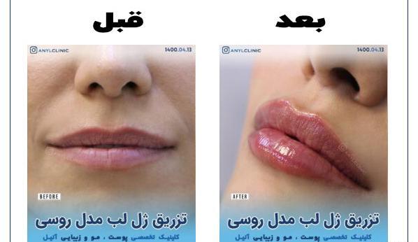 عکس قبل و بعد ژل لب روسی
