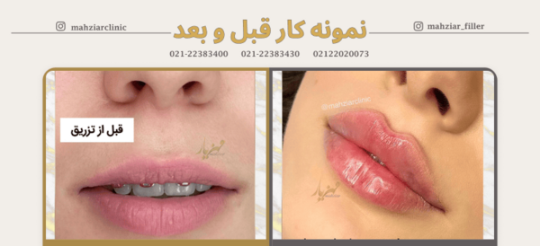 عکس قبل و بعد ژل لب روسی