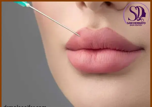 عکس قبل و بعد ورم ژل لب
