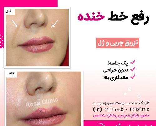 عکس قبل و بعد ورم ژل لب