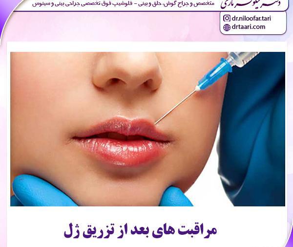 عکس قبل و بعد ورم ژل لب