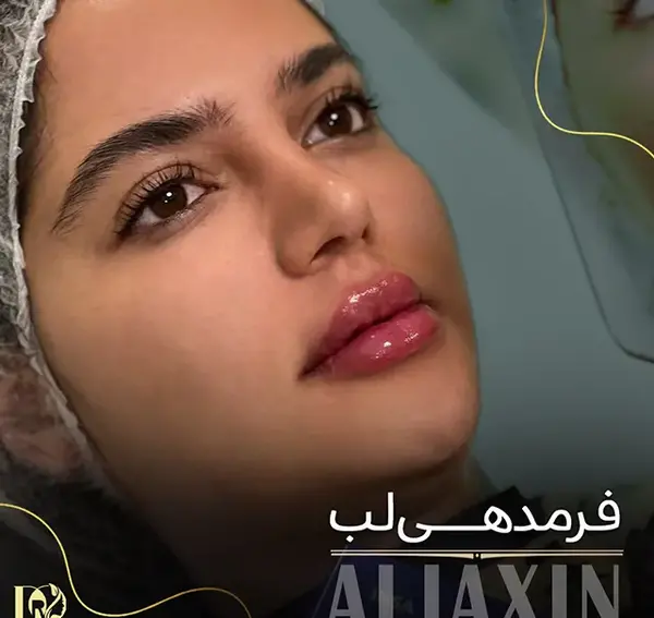 عکس قبل و بعد ورم ژل لب