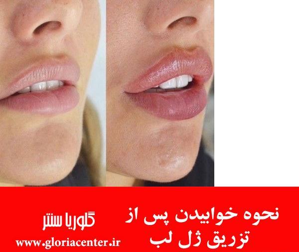 عکس قبل و بعد ورم ژل لب