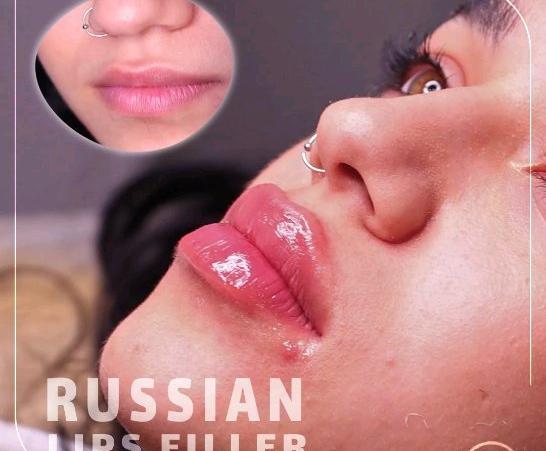 عکس های قبل و بعد ژل لب