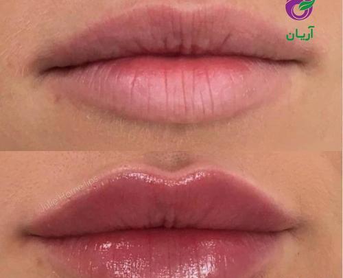 عکس های قبل و بعد ژل لب