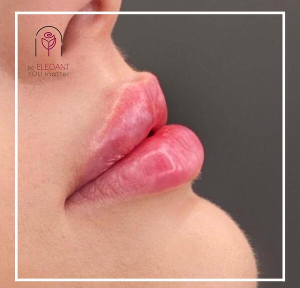 عکس های قبل و بعد ژل لب