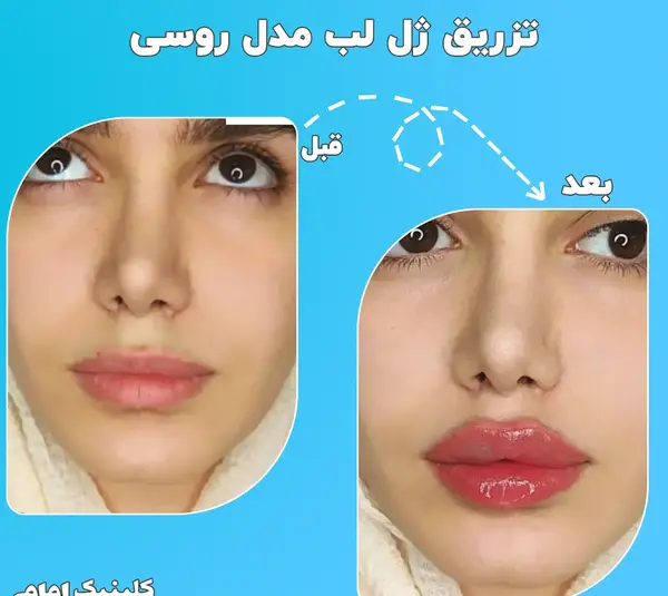 عکس قبل و بعد از ژل لب