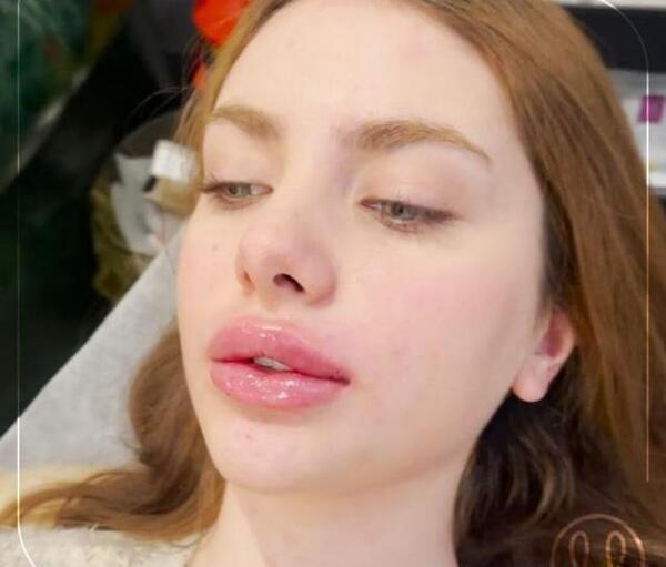 عکس قبل و بعد از ژل لب