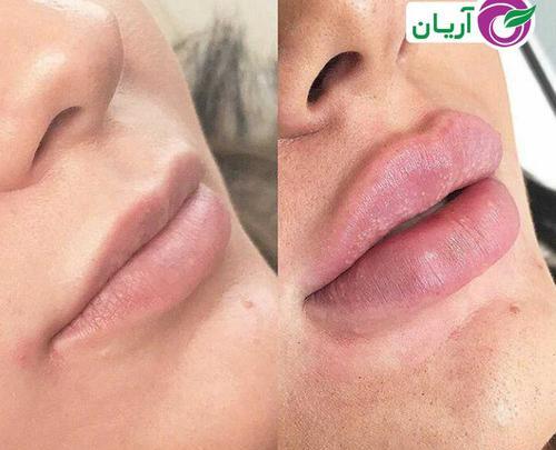 عکس قبل و بعد از ژل لب