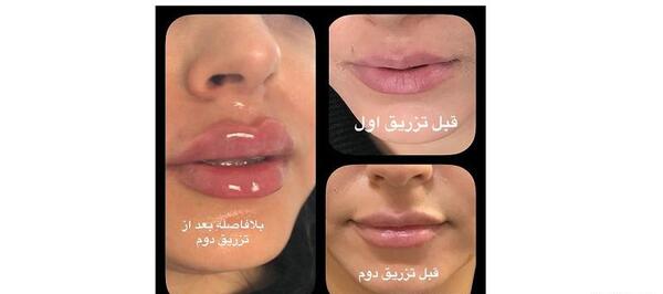 عکس قبل و بعد از ژل لب