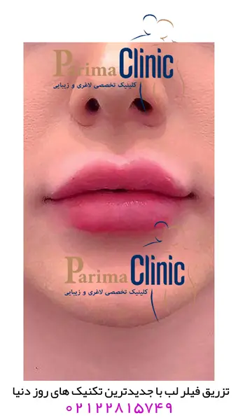 عکس قبل و بعد از ژل لب