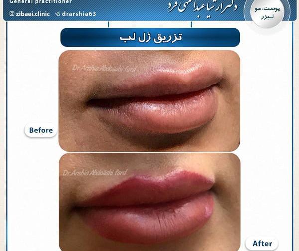 عکس قبل و بعد از ژل لب