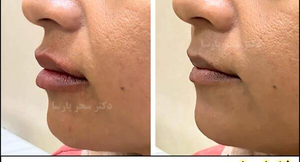 عکس قبل بعد ژل لب