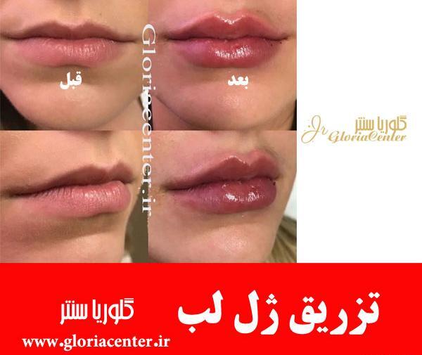 عکس قبل و بعد از تزریق ژل لب